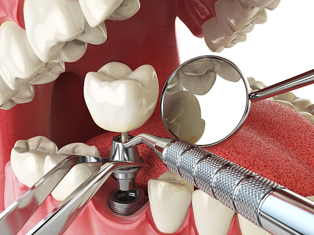 Best Urgent Care for Lost Fillings or Crowns in Grand Bay, AL